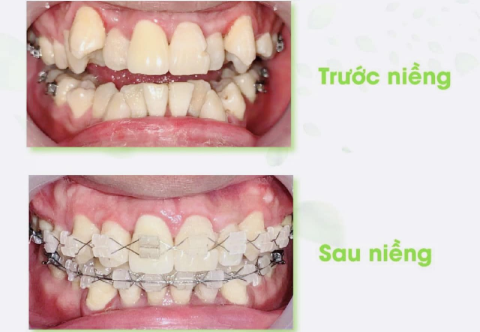 So sánh trước và sau niềng răng thay đổi như thế nào